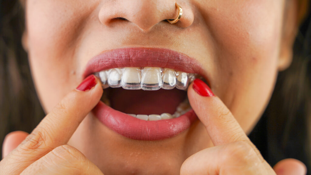Woman holding a clear aligner tray