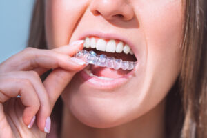 Woman inserting a clear aligner tray to straighten her teeth