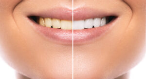 Before and after comparison of professionally whitened teeth