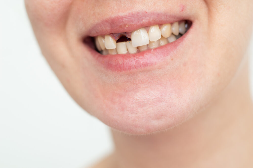 Smiling woman before dental implant treatment consultation