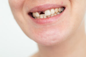 Smiling woman before dental implant treatment consultation